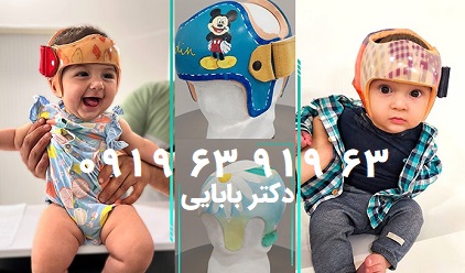 بررسی انواع بدشکلی، بدفرمی، دفرمی سر نوزاد