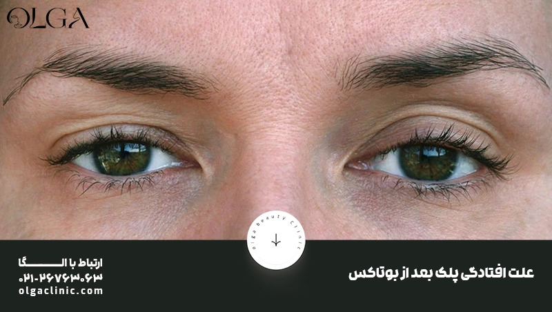 درمان | بوتاکس همه چیز درباره افتادگی پلک بعد از بوتاکس